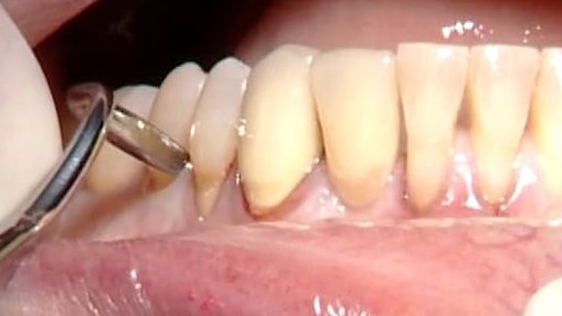 C1-3 AlloDerm Grafting of Mandibular Anterior Recession