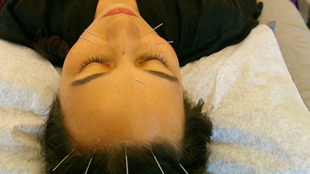 Popularity of acupuncture in US