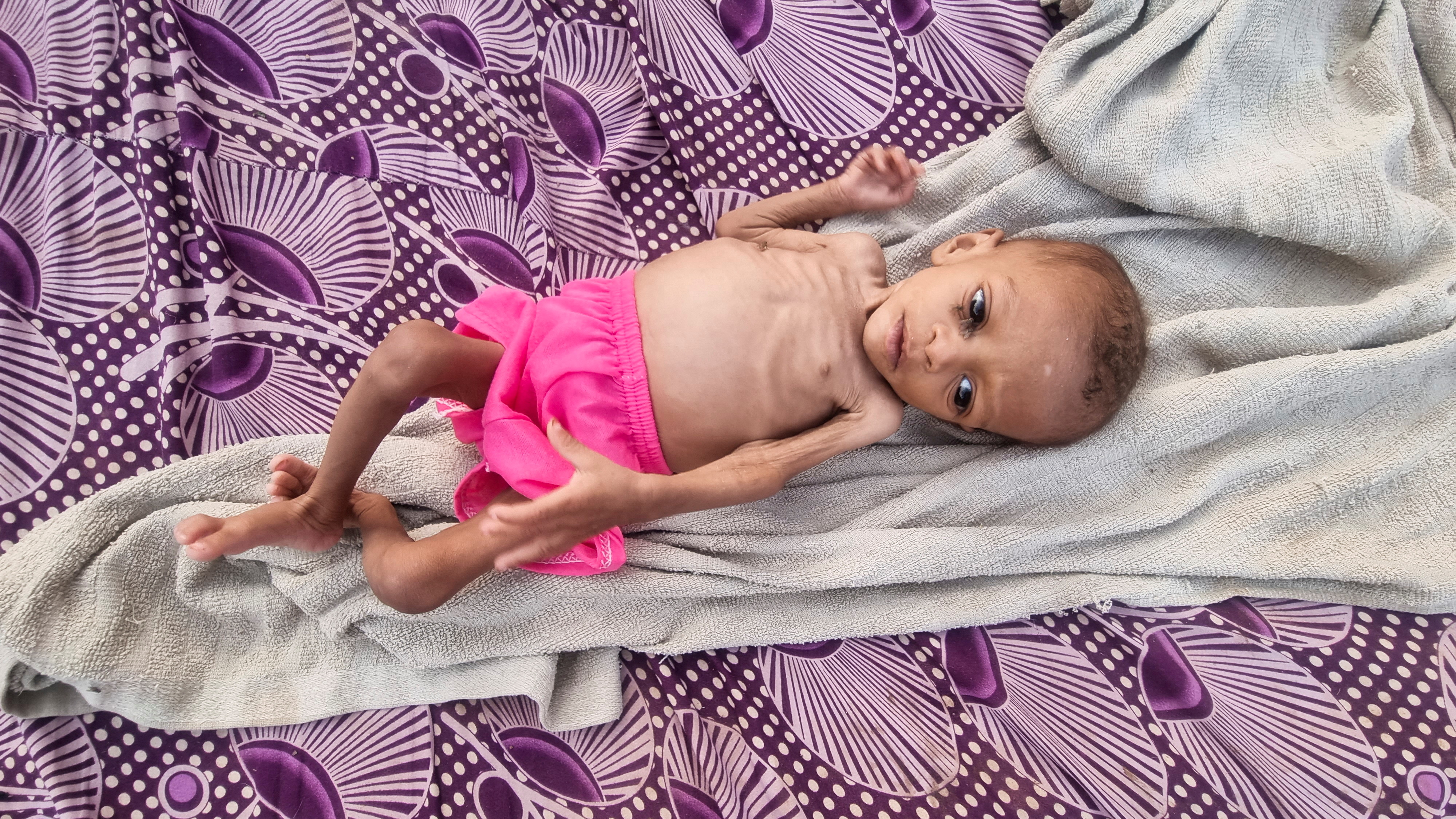 Conflict worsens global hunger