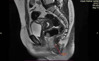 03/02/2023 - Dr. GI Kanhu Charan Patro - Radiation Oncology - India GI