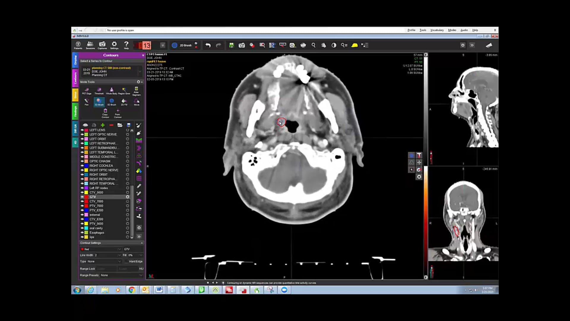 03/25/19 - Dr. David Sher - Radiation Oncology - Head and Neck US