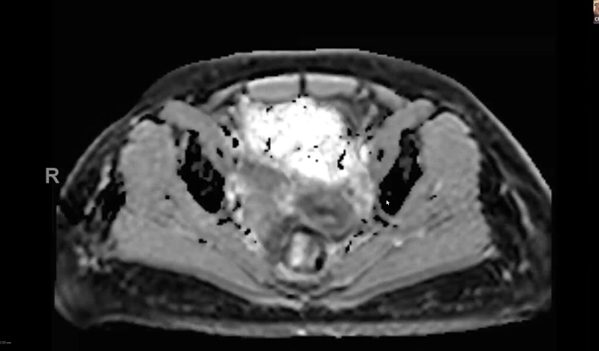 09/20/2023 - Dr. Christine Fisher - Radiation Oncology - GYN