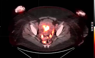 02/08/2023 - Dr. Christine Fisher - Radiation Oncology - US GYN