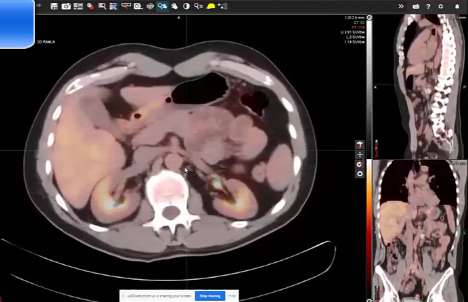 04/20/2022 - Dr. Andrea Ng - Radiation Oncology - Lymphoma