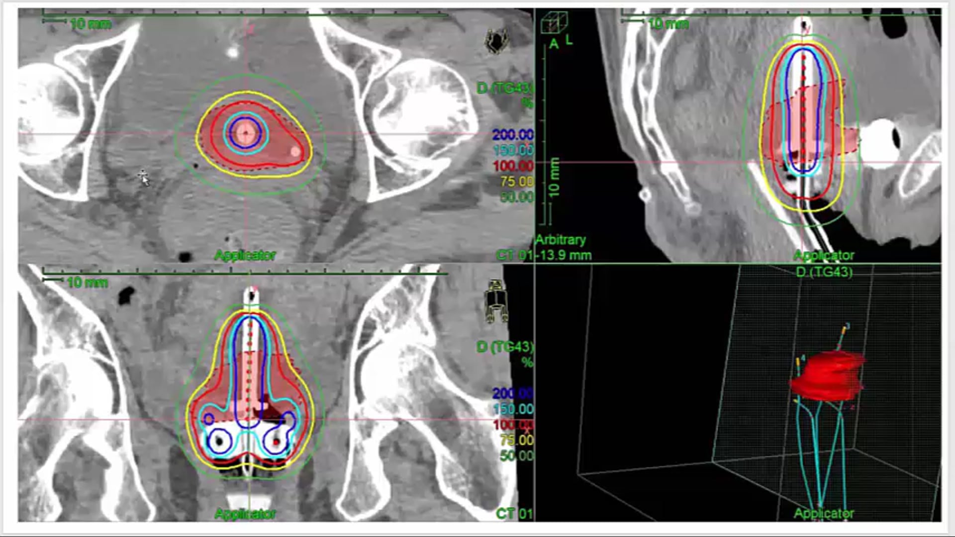 04/23/20 - Dr. David Gaffney - Radiation Oncology - GYN Brachytherapy