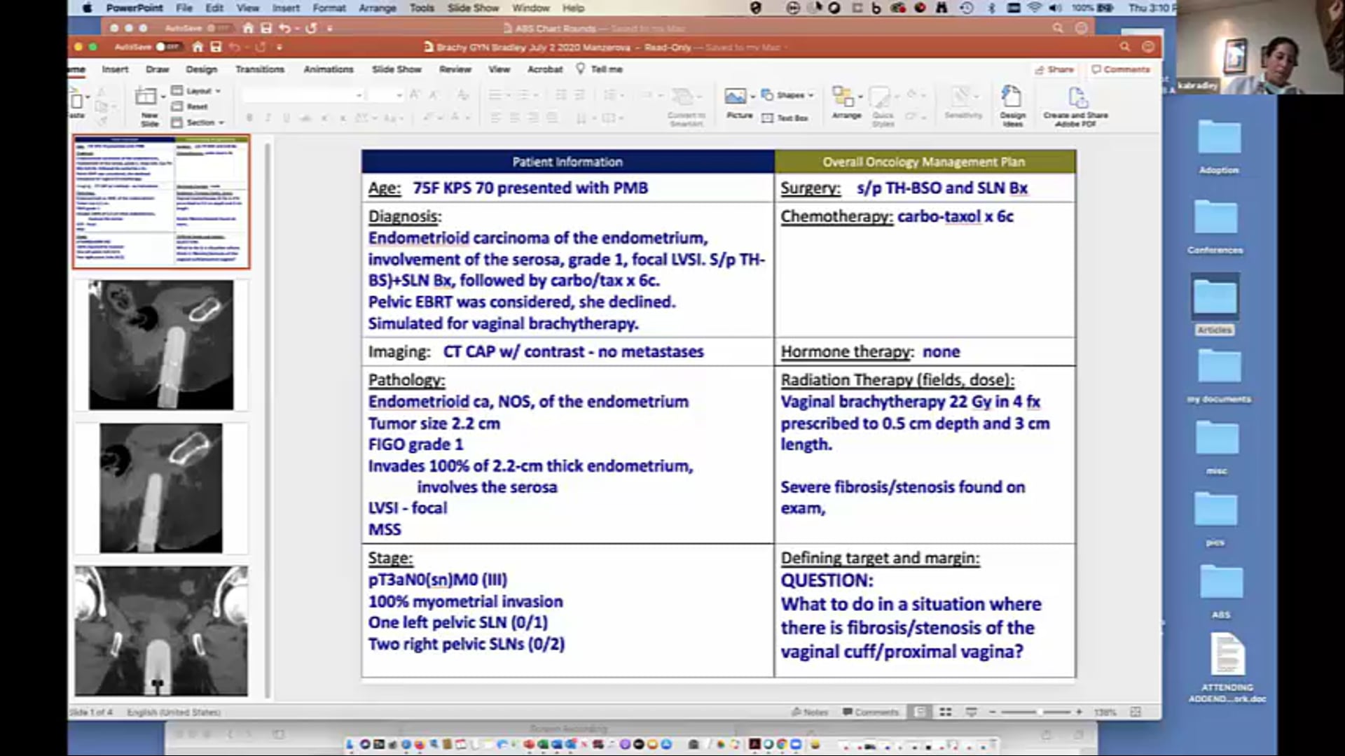 07/02/20 - Dr. Kristin Bradley - Radiation Oncology - GYN Brachytherapy