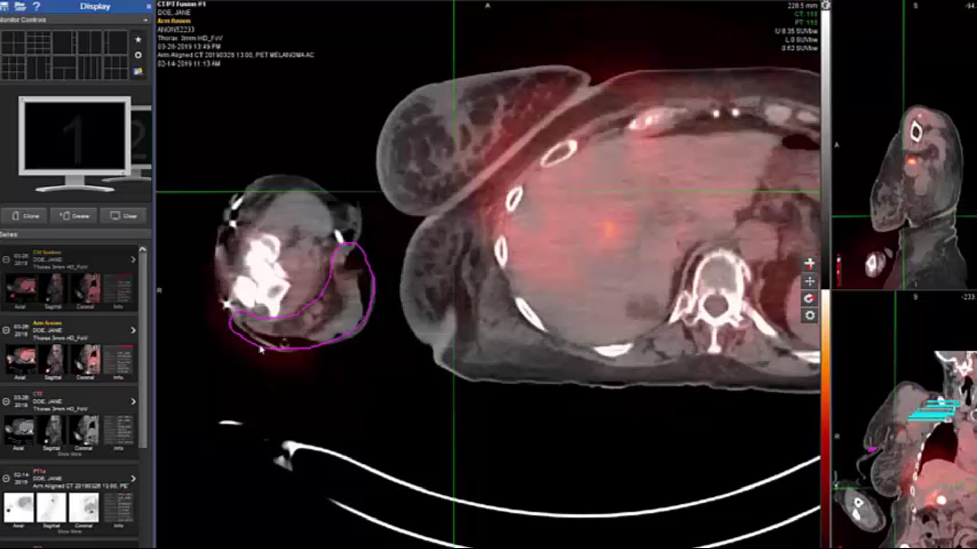 06/06/19 - Dr. Candice Johnstone - Radiation Oncology - Palliative Care US