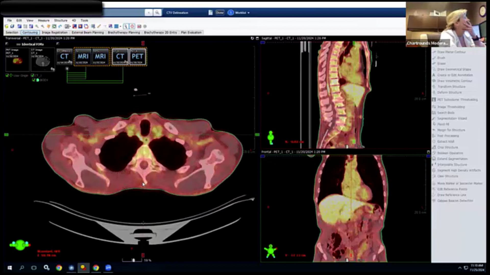 11/25/2024 Dr. Davd Sher - Radiation Oncology - Head and Neck