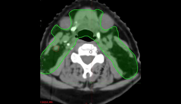 08/26/2024 - Dr. David Sher - Radiation Oncology - Head and Neck