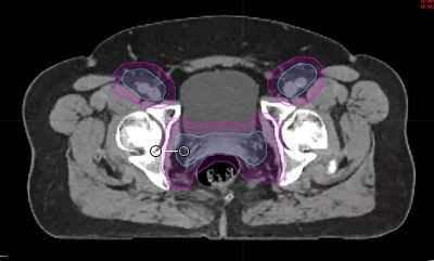 07/24/2025 - Dr. Beth Erickson - Radiation Oncology - GYN