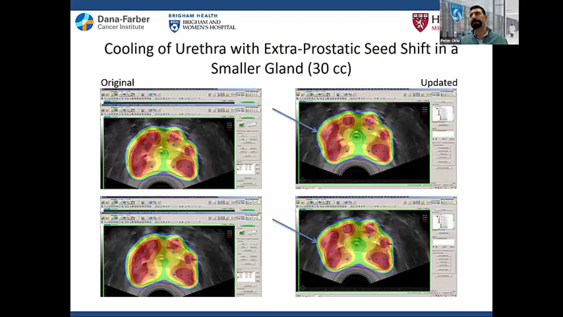 03/18/21 - Dr. Peter Orio - Radiation Oncology - Prostate Brachytherapy