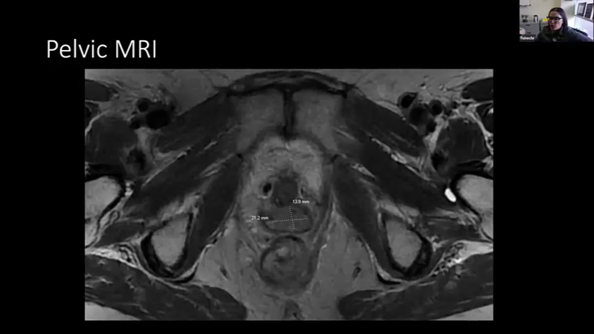 04/22/21 - Dr. Christine Fisher - Radiation Oncology - GYN Brachytherapy