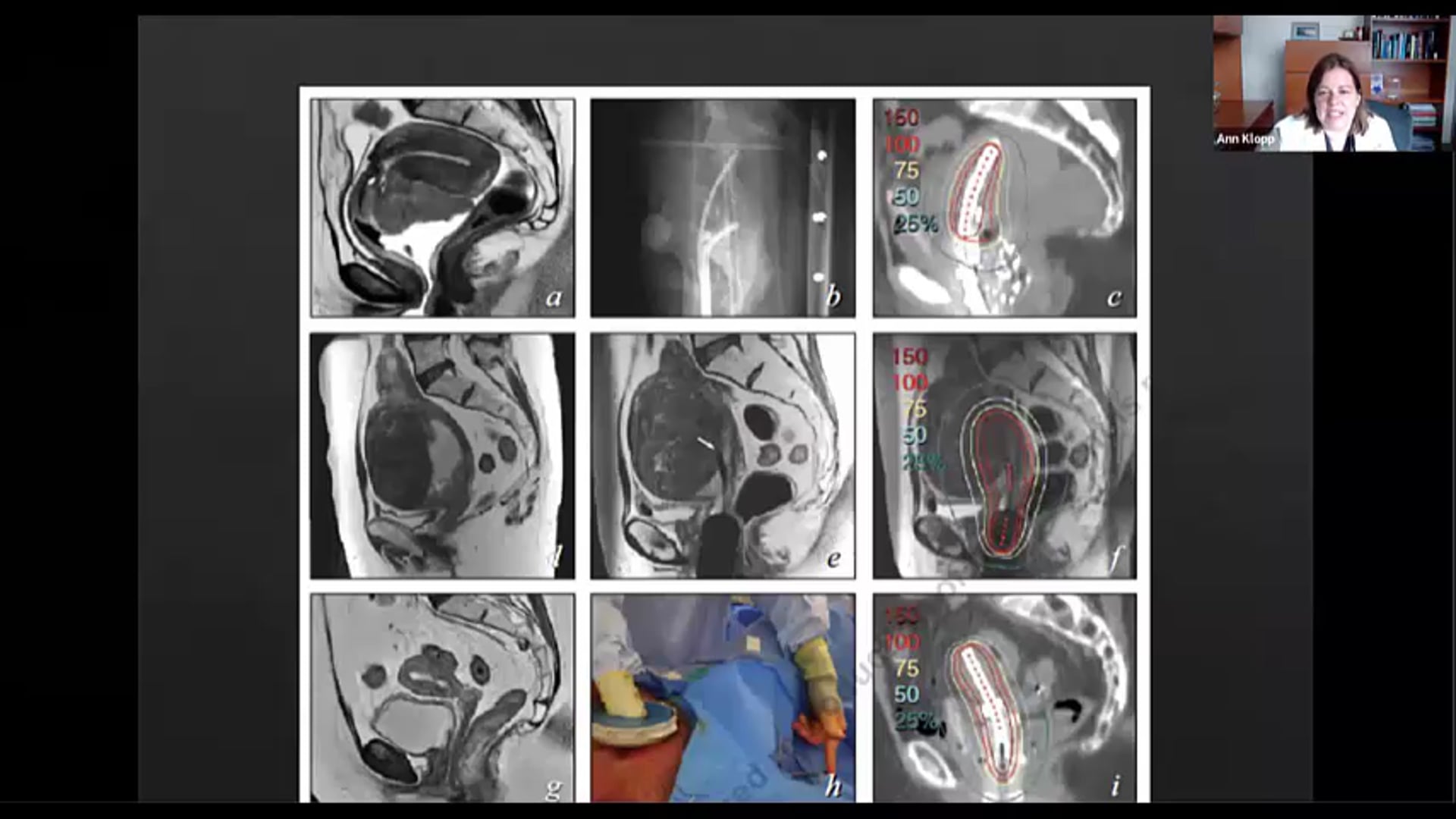 11/12/20 - Dr. Ann Klopp - Radiation Oncology - GYN Brachytherapy