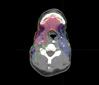 11/28/2022 - Dr. David Sher - Radiation Oncology - US Head & Neck