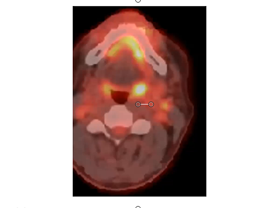 08/10/2021 - Dr. Kenneth Hu - Radiation Oncology - US Head & Neck