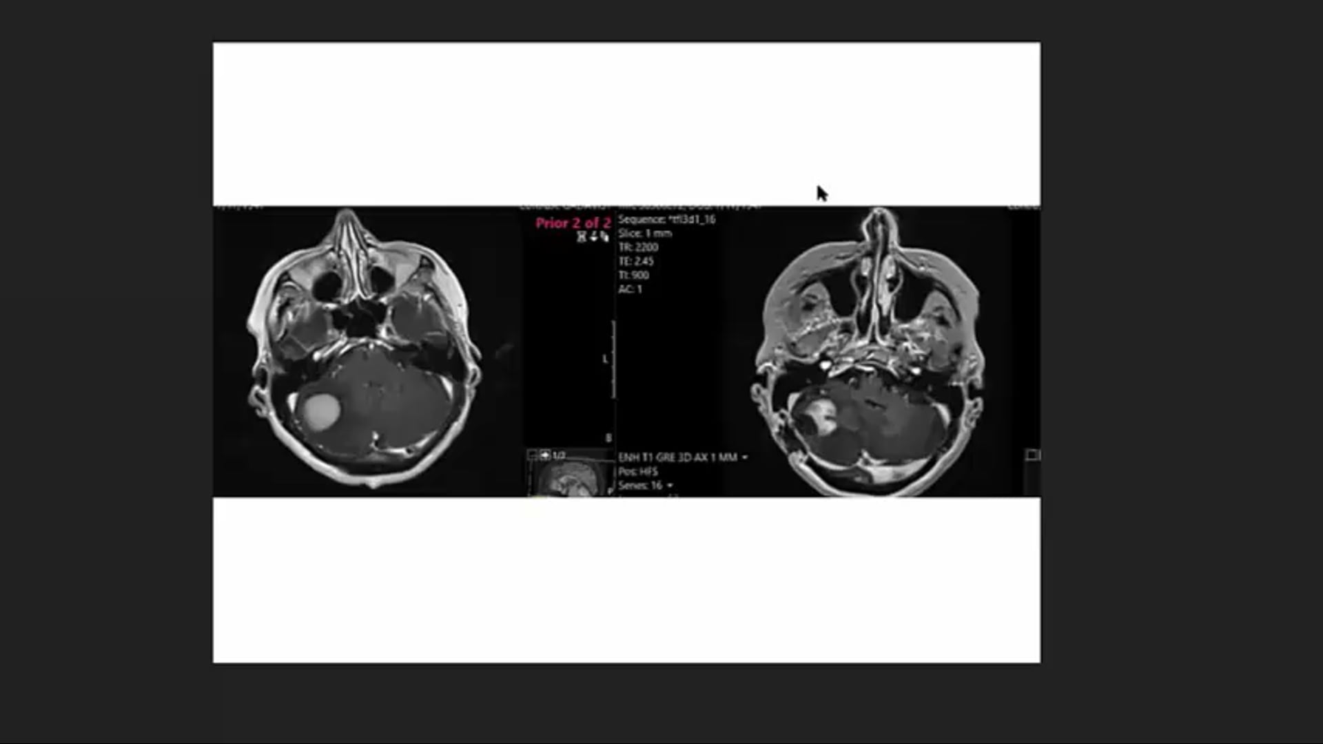 Chartrounds US - Lymphoma