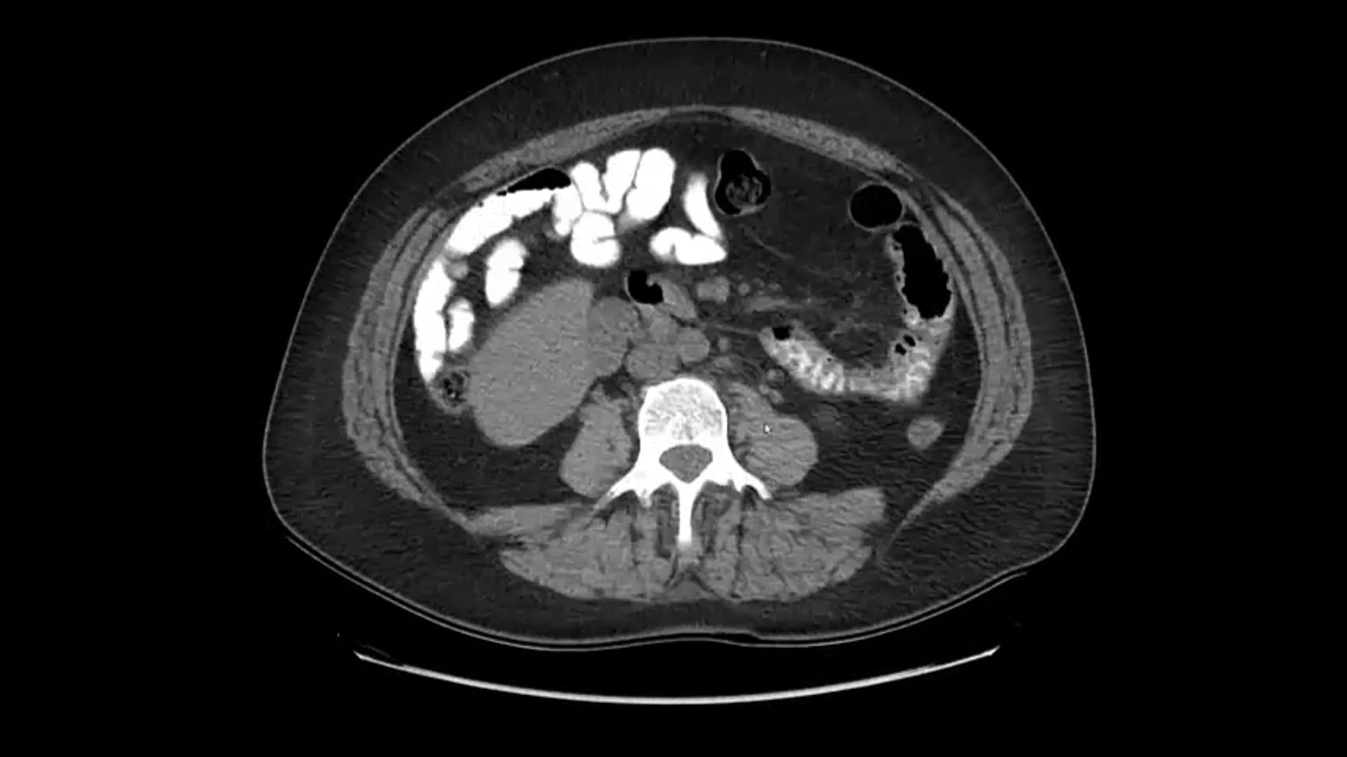 06/18/20 - Dr. Catheryn Yashar - Radiation Oncology - GYN Brachytherapy