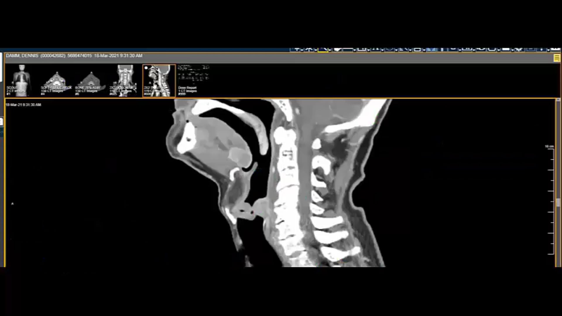 03/29/21 - Dr. David Sher - Radiation Oncology - Head and Neck US