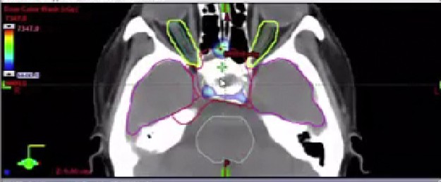 12/29/2025 - Dr. David Sher - Radiation Oncology - Head & Neck