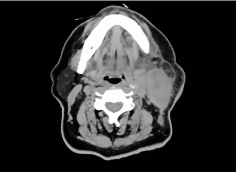 09/26/2022 - Dr. David Sher - Radiation Oncology - Head & Neck