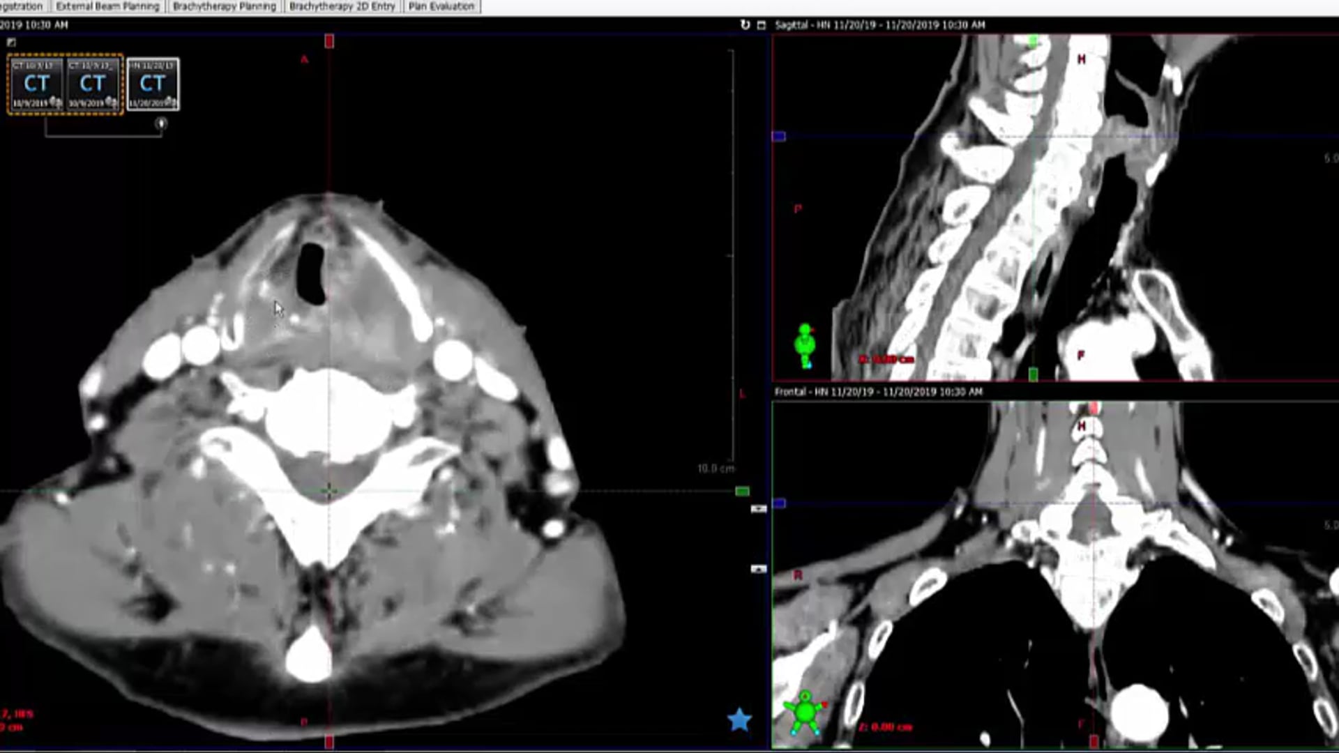 11/25/19 - Dr. David Sher - Radiation Oncology - Head and Neck US