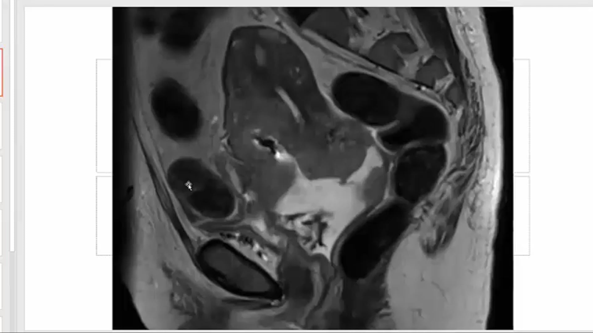 09/15/20 - Dr. David Gaffney - Radiation Oncology - GYN US