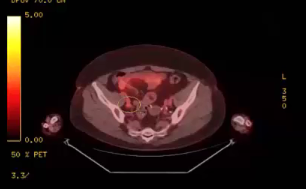 06/14/2023 - Dr. Christine Fisher - Radiation Oncology - GYN