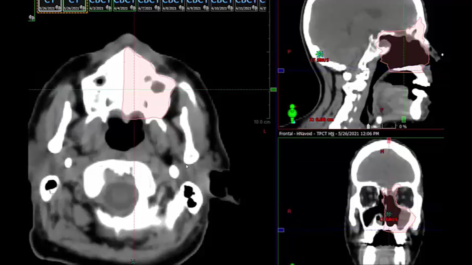 06/28/2021 Dr. David Sher - Radiation Oncology - Head & Neck