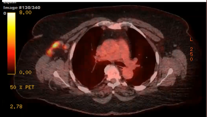 09/23/2023 - Dr. Abram Recht - Radiation Oncology - Breast 