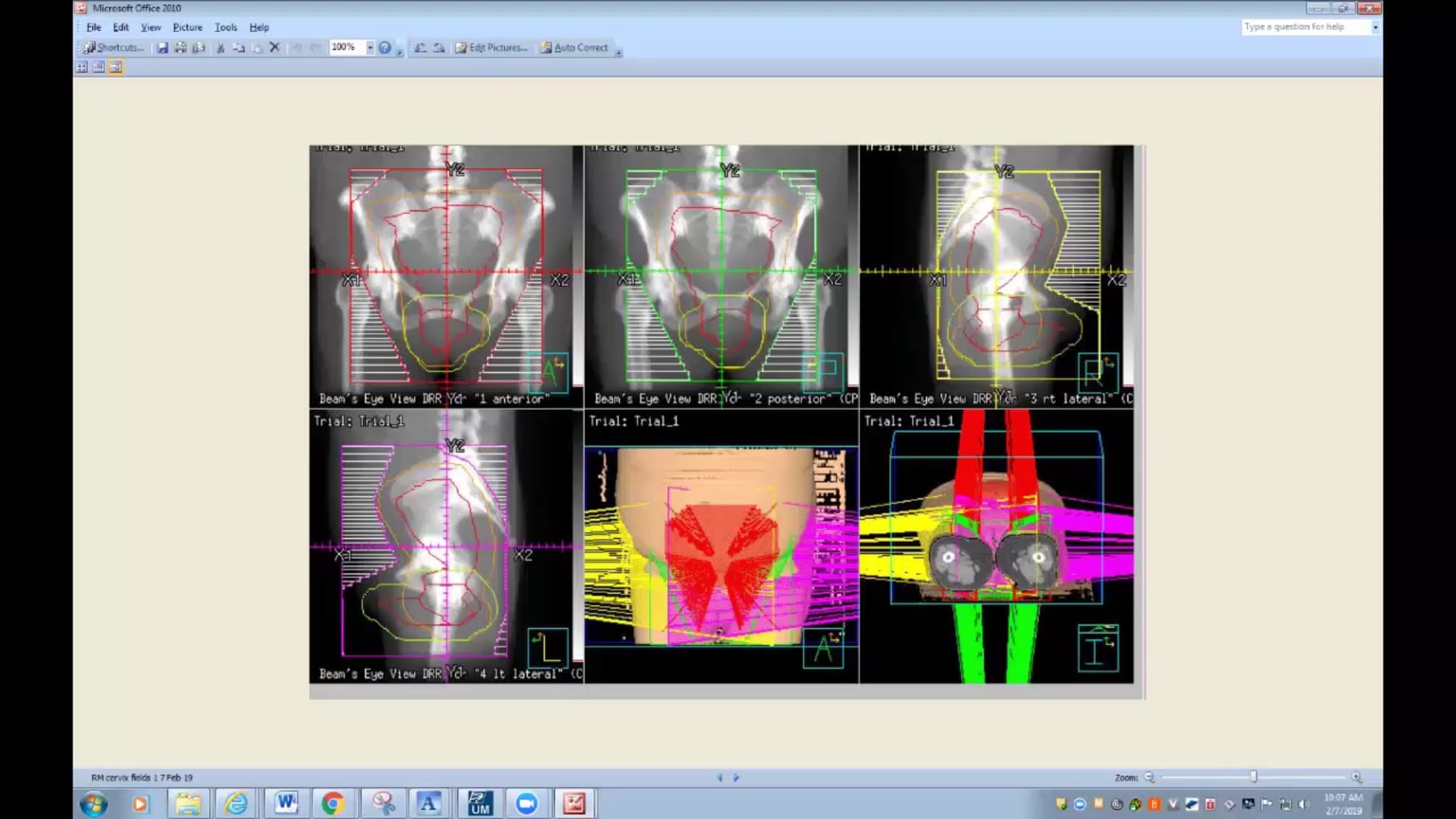 02/07/19 - Dr. Candice Johnstone - Radiation Oncology - Palliative Care US