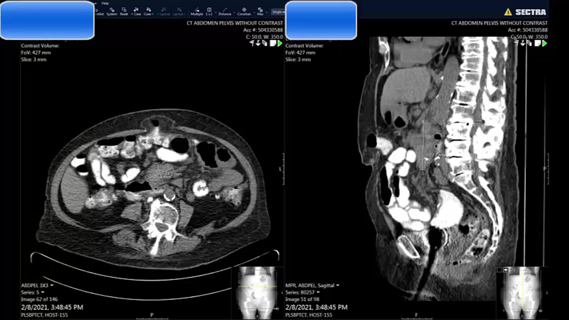 02/10/21 - Dr. Harvey Mamon - Radiation Oncology - GI