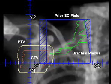 05/24/2024 - Dr. Abram Recht- Radiation Oncology - Breast