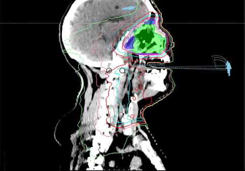 03/31/2025 - Dr. David Sher - Radiation Oncology - Head and Neck