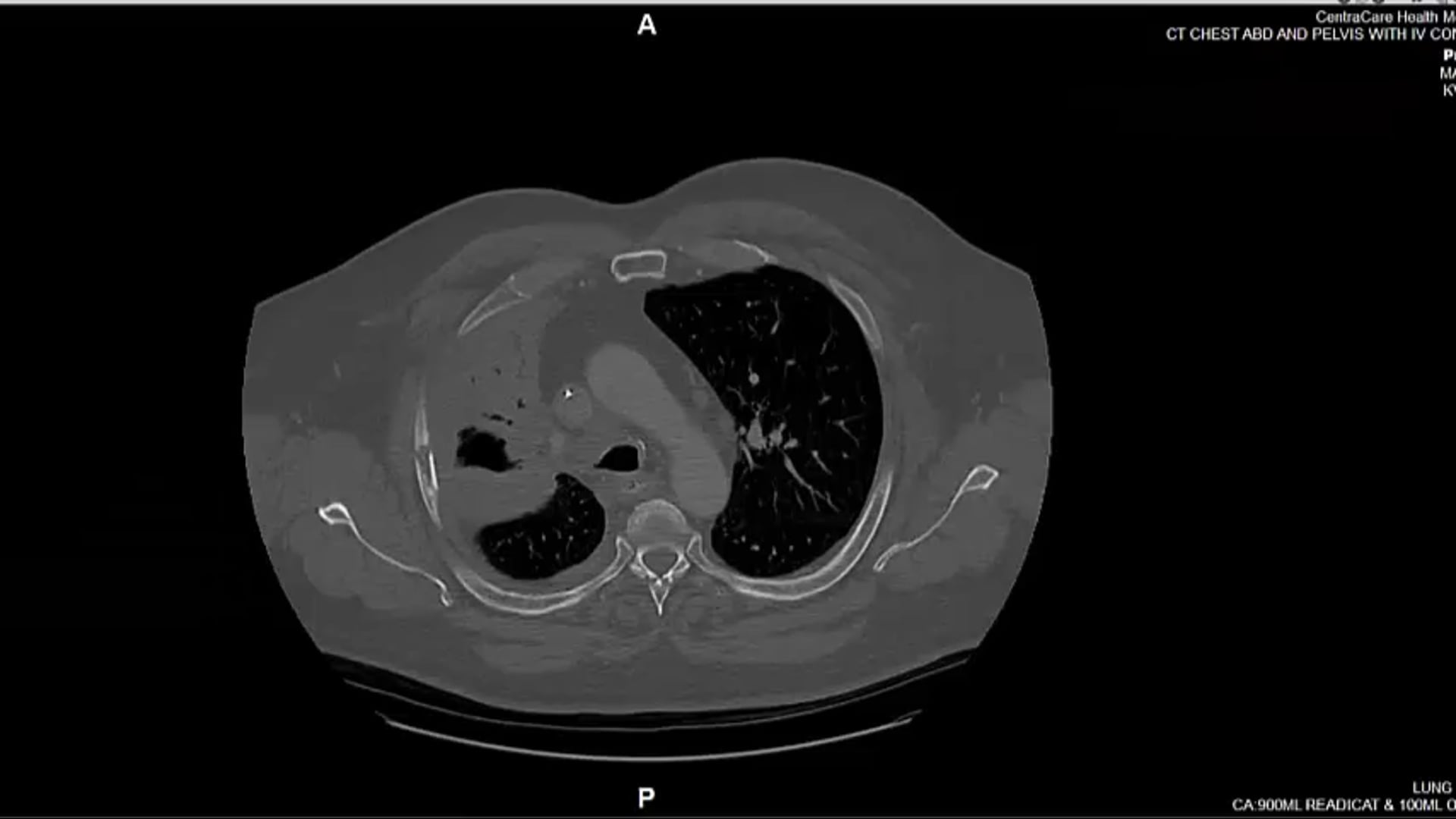 11/21/19 - Dr. Candice Johnstone - Radiation Oncology - Lung US