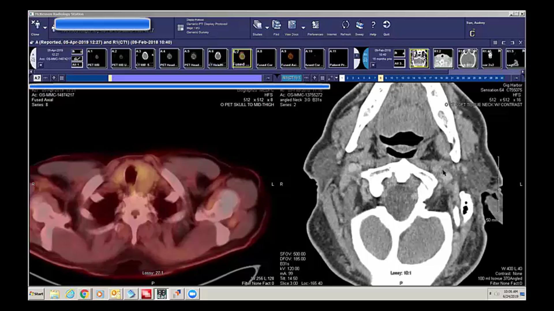 06/24/19 - Dr. David Sher - Radiation Oncology - Head and Neck US