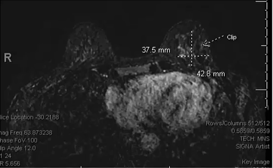 10/27/2023 - Dr. Abram Recht - Radiation Oncology - Breast 