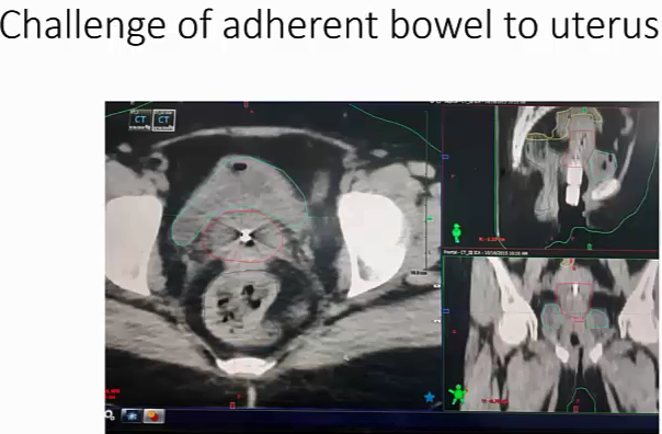 10/13/22 - Dr. Vasanth Christopher - Radiation Oncology - India GYN Brachy