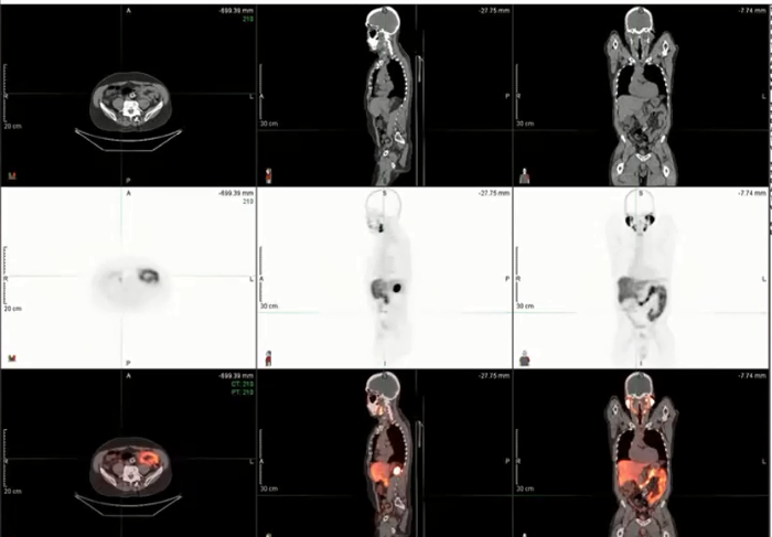 09/22/2022 - Dr. Ronald Chen - Radiation Oncology - US GU