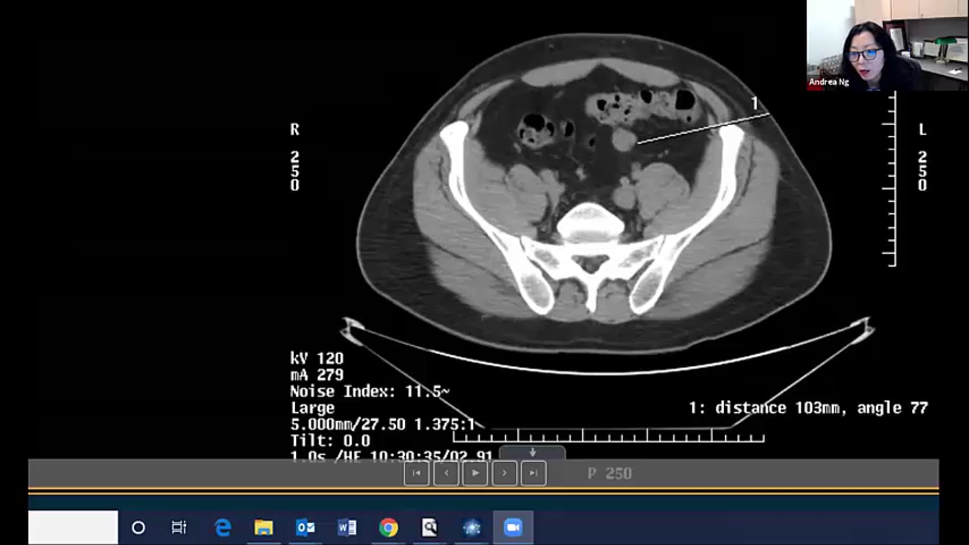 04/21/21 - Dr. Andrea Ng - Radiation Oncology - Lymphoma