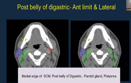 09/29/2022 - Dr.Kainickal Cessal Thomas - Radiation Oncology - India Head & Neck