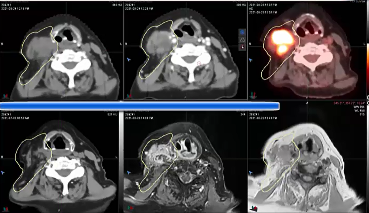 08/30/2021 - Dr. David Sher  - Radiation Oncology - US Head & Neck