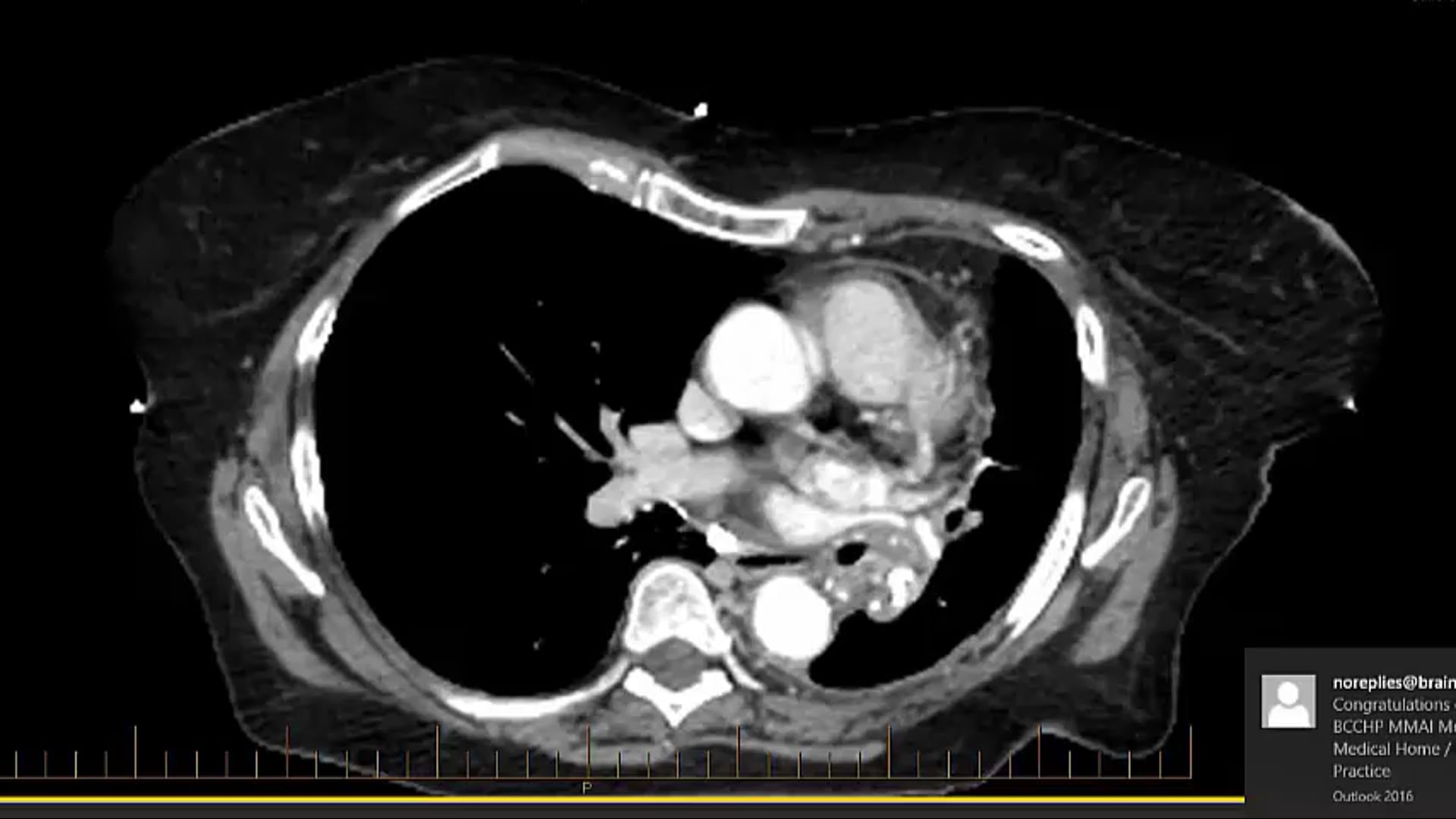 10/29/20 - Dr. Candice Johnstone - Radiation Oncology - Lung US