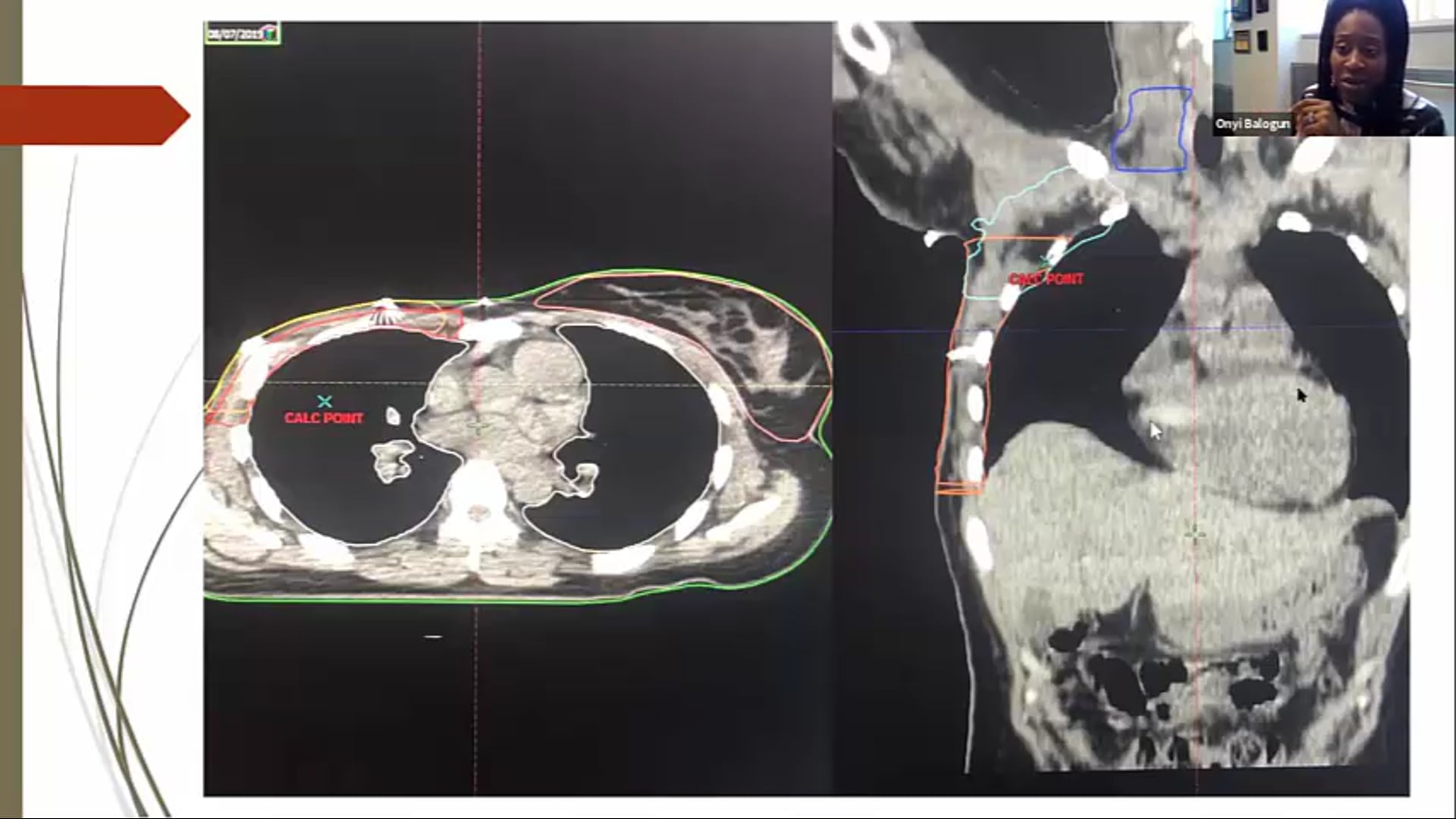 08/05/19 - Dr. Onyinye Balogun - Radiation Oncology - Breast Africa