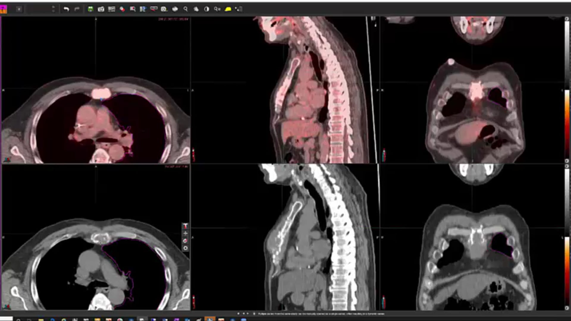 11/15/19 - Dr. Leonard Prosnitz - Radiation Oncology - Leukemia - Lymphoma US