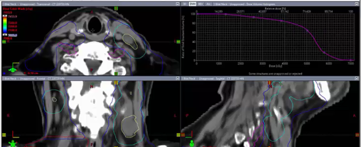 08/01/2022 - Dr. David Sher - Radiation Oncology - Head & Neck