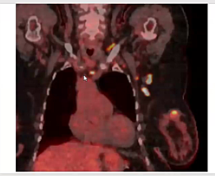 04/26/2024 - Dr. Abram Recht - Radiation Oncology - Breast
