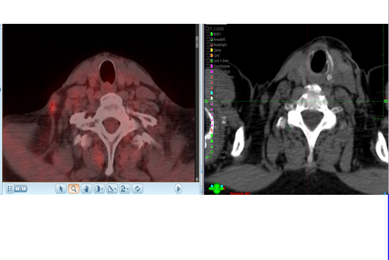 11/11/2022- Dr. Abram Recht - Radiation Oncology - US Breast