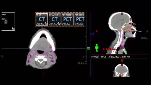 03/27/2023 - Dr. David Sher - Radiation Oncology - US Head and Neck