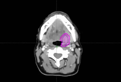 06/24/024 - Dr. David Sher - Radiation Oncology - Head & Neck