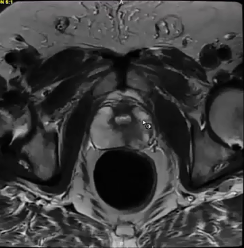 01/26/2023 - Dr. Patricia H. Hardenbergh  - Radiation Oncology - US GU